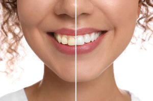 Top 5 Myths About Teeth Whitening Debunked - Bridge Dental